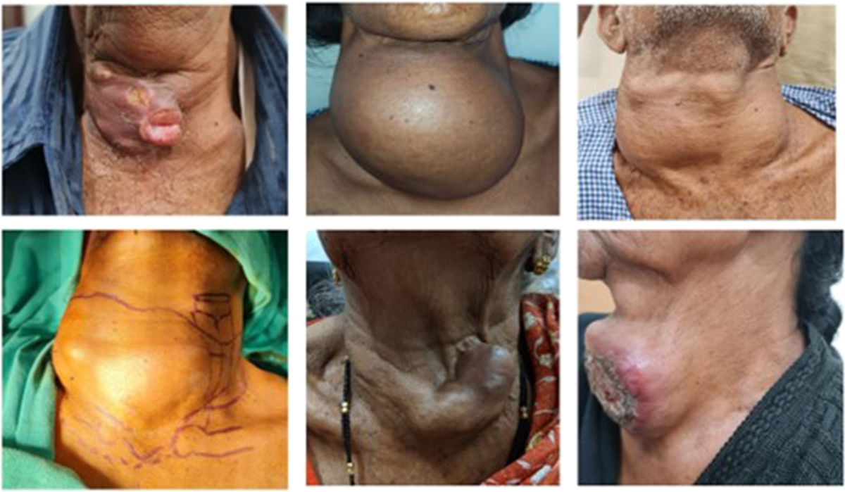 Thyroid cancer statistics infographic